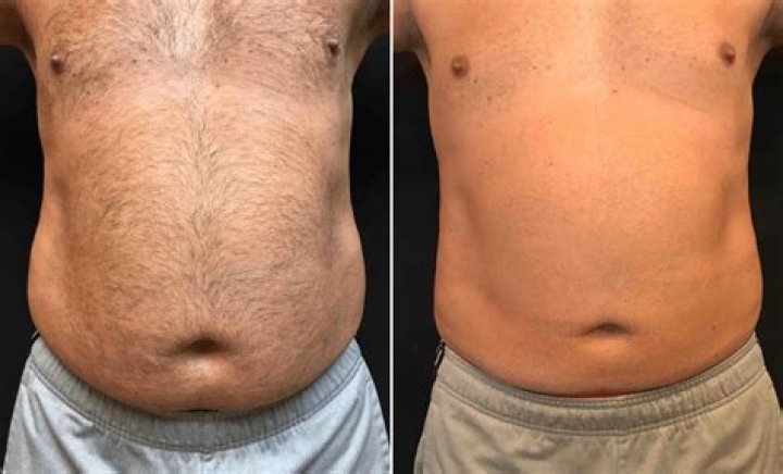 1st Photos After CoolSculpting Procedure – Hollywood Life