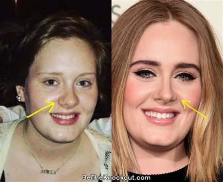 Adele Nose Job