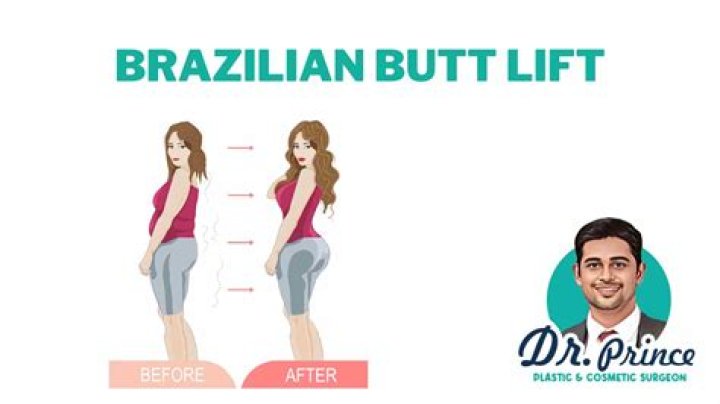 Are Brazilian Butt Lifts Still Popular with Celebrities?
