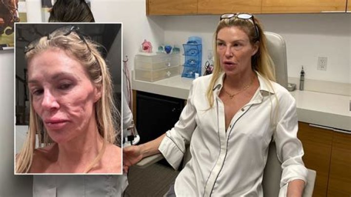 Brandi Glanville’s Terrifying Laser Hair Removal Saga: It Paralyzed Half My Face
