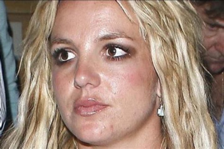 Britney Spears Acne