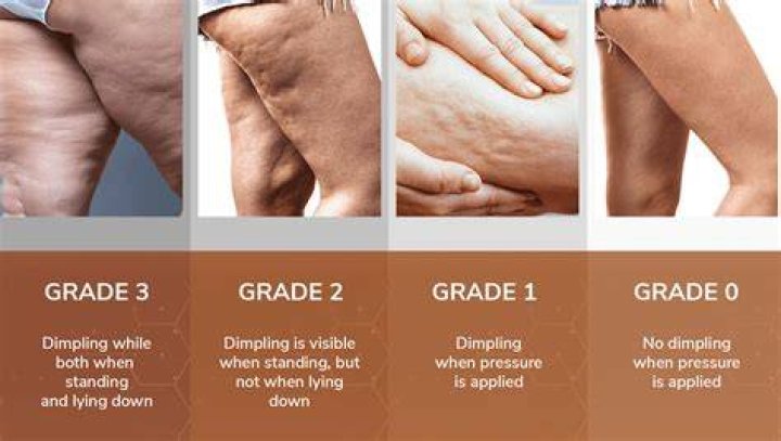 cellulite