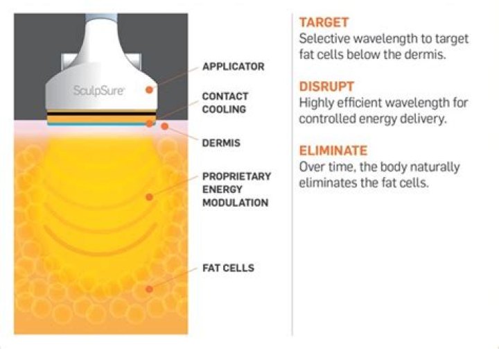 Does SculpSure Work?