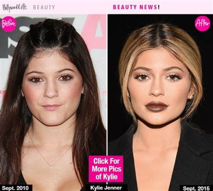 FDA Approves Lip Filler That Lasts A Year — Will Kylie Jenner Do It?