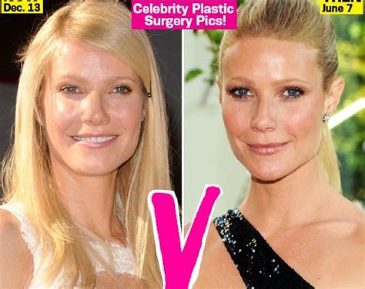 Fillers, Botox & Laser Treatments Gave Gwyneth Paltrow Her Puffy New Face! – Hollywood Life