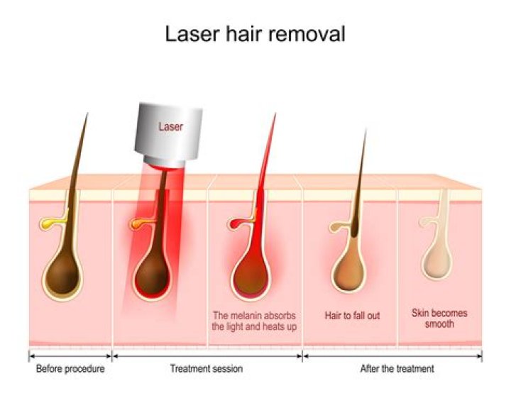 hair removal laser