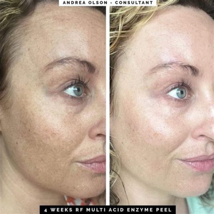 Highest-Rated Enzyme Peel of 2023 – Hollywood Life Reviews – Hollywood Life