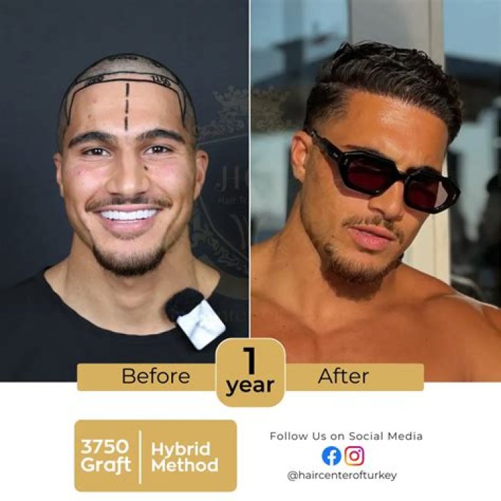 How Effective Are Turkish Hair Transplants? – Hollywood Life