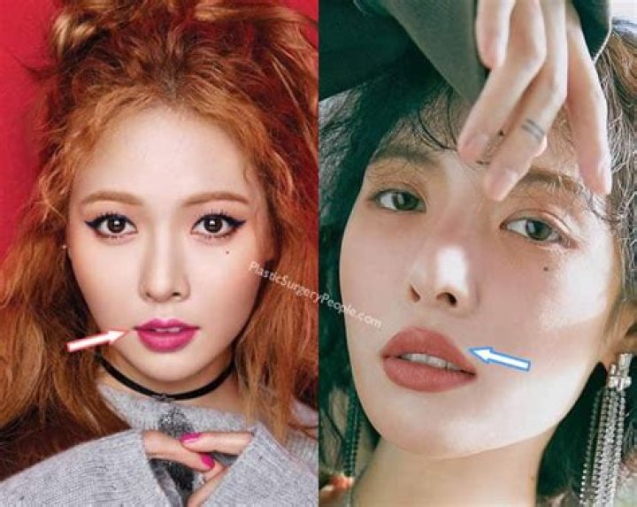 Hyuna Lip Injections