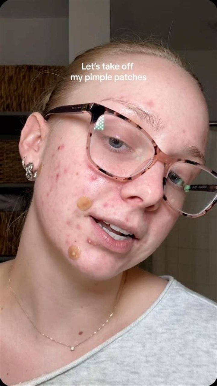 pimple-patches