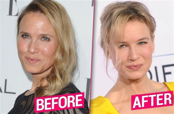 Renee Zellweger Plastic Surgery