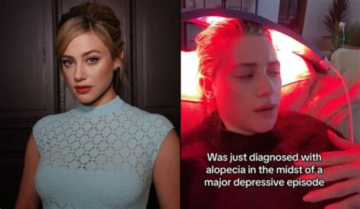 Riverdale’s Lili Reinhart Reveals Alopecia Diagnosis Amid ‘Major Depressive Episode’