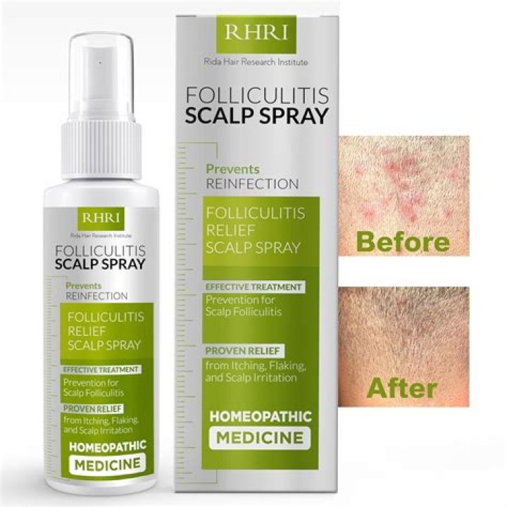 scalp spray