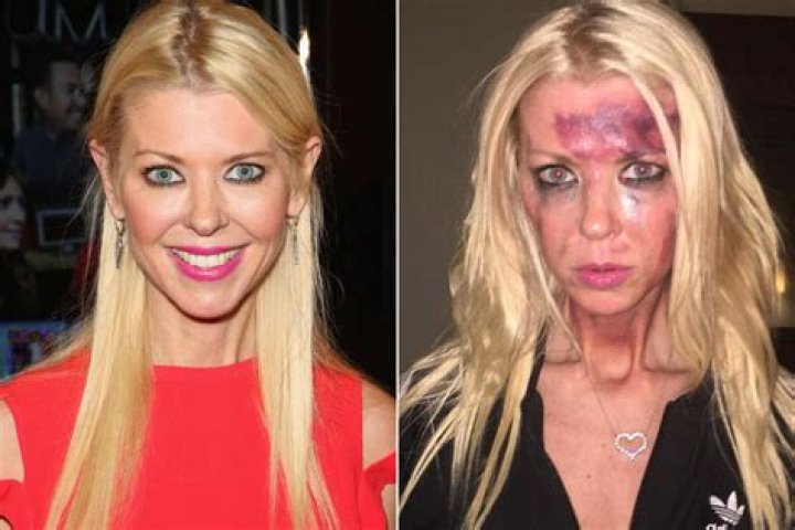Tara Reid Bruised Face