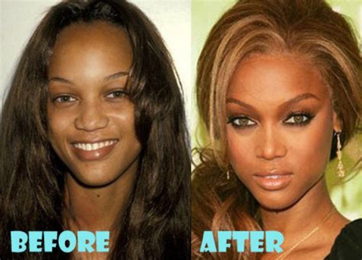 Tyra Banks Nose Job